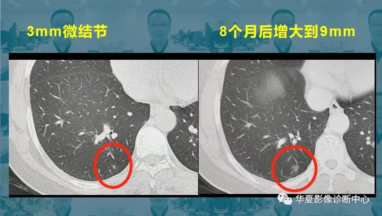 左肺发现13mm结节，严重与否的探讨