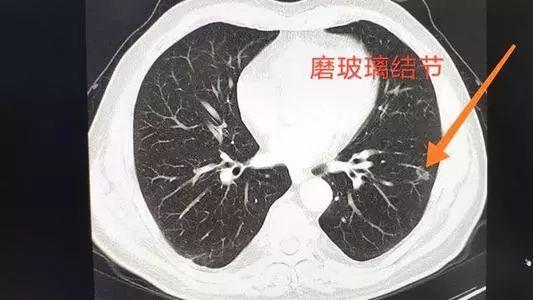 肺部健康的重要警示，面对13毫米结节的挑战